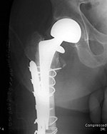 Bipolar hip prosthesis